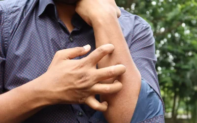 Studio Novartis, l’orticaria cronica spontanea costa 4.200 euro l’anno a paziente